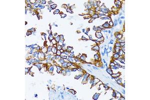 Immunohistochemistry of paraffin-embedded human lung cancer using Cytokeratin 7 (Cytokeratin 7 (KRT7)) antibody (ABIN6129292, ABIN6143037, ABIN6143039 and ABIN6215559) at dilution of 1:200 (40x lens). (Cytokeratin 7 antibody  (AA 1-94))