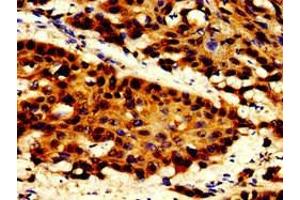 Immunohistochemistry of paraffin-embedded human cervical cancer using ABIN7150346 at dilution of 1:100 (TOP2B antibody  (AA 1400-1626))