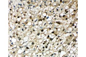 Anti-Selenium Binding Protein 1 antibody, IHC(P) IHC(P): Human Liver Cancer Tissue (SELENBP1 antibody  (Middle Region))