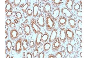 ABIN6383807 to Calnexin was successfully used to stain epithelial cells perinuclear in human renal carcinoma sections. (Calnexin antibody  (Lumenal Region))