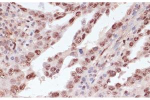 Immunohistochemistry of paraffin-embedded Human lung cancer using Phospho-ATF2(T71) Polyclonal Antibody at dilution of 1:100 (40x lens). (ATF2 antibody  (pThr71))