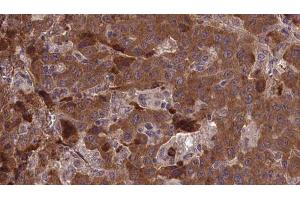 ABIN6277362 at 1/100 staining Human liver cancer tissue by IHC-P.