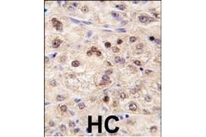 Formalin-fixed and paraffin-embedded human hepatocarcinoma tissue reacted with ZBTB7B antibody (Center) (ABIN390349 and ABIN2840763) , which was peroxidase-conjugated to the secondary antibody, followed by DAB staining. (ZBTB7B antibody  (AA 181-210))