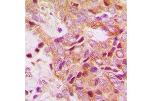 Immunohistochemical analysis of RPS13 staining in human breast cancer formalin fixed paraffin embedded tissue section. (RPS13 antibody)