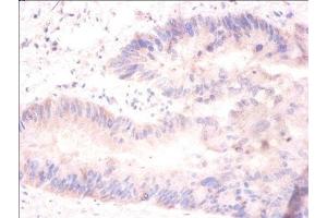 Immunohistochemistry of paraffin-embedded human colon cancer using ABIN7155377 at dilution of 1:100