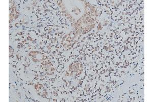ABIN6267039 at 1/200 staining human breast cancer tissue sections by IHC-P. (Histone 3 antibody)