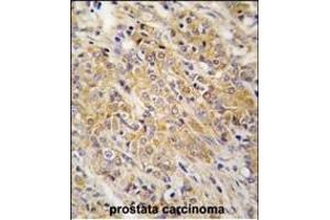 Forlin-fixed and paraffin-embedded hun prostata carcino tissue reacted with P2K2 Antibody  (ABIN1881526 and ABIN2842063) , which was peroxidase-conjugated to the secondary antibody, followed by DAB staining. (MEK2 antibody  (AA 200-229))