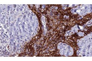 ABIN6279127 at 1/100 staining Human Head and neck cancer tissue by IHC-P. (SLC4A3 antibody  (N-Term))