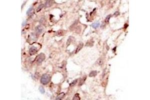 IHC analysis of FFPE human breast carcinoma tissue stained with the SUV39H2 antibody (SUV39H2 antibody  (AA 360-390))