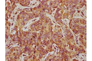 IHC image of ABIN7165837 diluted at 1:500 and staining in paraffin-embedded human liver cancer performed on a Leica BondTM system. (NTAN1 antibody  (AA 219-310))