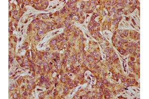 IHC image of ABIN7165837 diluted at 1:500 and staining in paraffin-embedded human liver cancer performed on a Leica BondTM system.