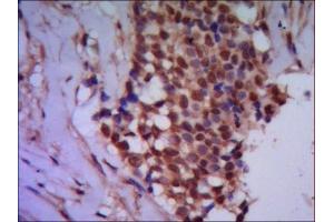 IHC of paraffin-embedded human breast cancer using anti-Protein Phosphatase 4C mouse mAb diluted 1/500-1/1000. (Protein Phosphatase 4C antibody)