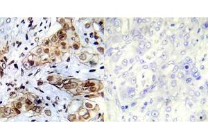 Immunohistochemical analysis of paraffin- embedded human breast carcinoma tissue using Abl1 (Ab-412) antibody (E022002). (ABL1 antibody)
