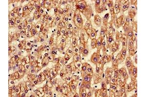 Immunohistochemistry of paraffin-embedded human liver cancer using ABIN7144713 at dilution of 1:100 (Asialoglycoprotein Receptor 2 antibody  (AA 63-286))