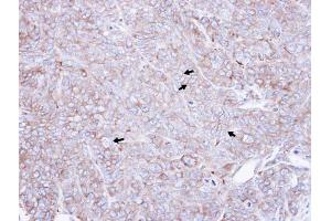 IHC-P Image Immunohistochemical analysis of paraffin-embedded DLD1 xenograft , using CAP1, antibody at 1:500 dilution. (CAP1 antibody  (Center))