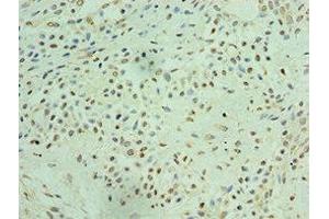 Immunohistochemistry of paraffin-embedded human breast cancer using ABIN7172050 at dilution of 1:100 (THOC1 antibody  (AA 428-657))