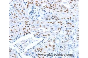 Immunohistochemistry of Human gastric cancer using ARID1A Polyclonal Antibody at dilution of 1:80 (ARID1A antibody)