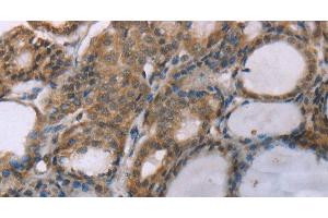 Immunohistochemistry of paraffin-embedded Human thyroid cancer using ACTN2 Polyclonal Antibody at dilution of 1:30 (ACTN2 antibody)