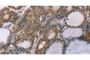 Immunohistochemistry of paraffin-embedded Human thyroid cancer using ACTN2 Polyclonal Antibody at dilution of 1:30 (ACTN2 antibody)