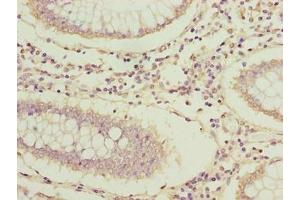 Immunohistochemistry of paraffin-embedded human colon cancer using ABIN7144631 at dilution of 1:100 (ARPIN antibody  (AA 1-226))