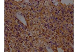IHC image of ABIN7152226 diluted at 1:200 and staining in paraffin-embedded human glioma cancer performed on a Leica BondTM system. (SLC1A3 antibody  (AA 146-236))