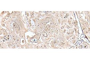 Immunohistochemistry of paraffin-embedded Human esophagus cancer tissue using VRK3 Polyclonal Antibody at dilution of 1:45(x200) (VRK3 antibody)