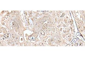 Immunohistochemistry of paraffin-embedded Human esophagus cancer tissue using VRK3 Polyclonal Antibody at dilution of 1:45(x200)