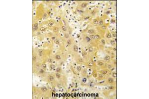Formalin-fixed and paraffin-embedded human hepatocarcinoma tissue reacted with Tiparp antibody , which was peroxidase-conjugated to the secondary antibody, followed by DAB staining.