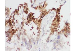 Anti-PGK1 antibody, IHC(P) IHC(P): Human Lung Cancer Tissue (PGK1 antibody  (Middle Region))