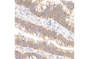 Immunohistochemistry of paraffin-embedded human colon carcinoma using GFPT1 Rabbit mAb (ABIN7267430) at dilution of 1:150 (40x lens). (GFPT1 antibody)