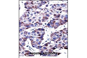DUSP9 Antibody (C-term) ((ABIN657812 and ABIN2846780))immunohistochemistry analysis in formalin fixed and paraffin embedded human hepatocarcinoma followed by peroxidase conjugation of the secondary antibody and DAB staining. (DUSP9 antibody  (C-Term))