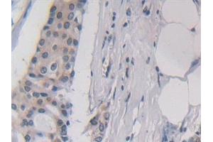Detection of IL5 in Human Breast cancer Tissue using Polyclonal Antibody to Interleukin 5 (IL5) (IL-5 antibody  (AA 20-134))