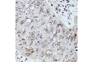 Immunohistochemistry of paraffin-embedded human esophageal cancer using GOLGB1 Rabbit pAb (ABIN7267498) at dilution of 1:100 (40x lens).