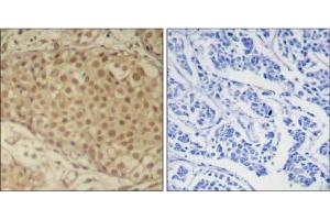 Immunohistochemical analysis of paraffin-embedded human breast carcinoma tissue using Smad2 (Ab-220) Antibody (E021323). (SMAD2 antibody)