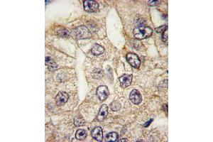 Formalin-fixed and paraffin-embedded human lung carcinoma tissue reacted with CD14 antibody , which was peroxidase-conjugated to the secondary antibody, followed by DAB staining. (CD14 antibody  (N-Term))