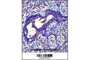ACTG2 Antibody immunohistochemistry analysis in formalin fixed and paraffin embedded human prostate cancinoma followed by peroxidase conjugation of the secondary antibody and DAB staining.