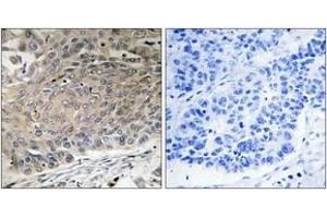Immunohistochemistry analysis of paraffin-embedded human lung carcinoma tissue, using DYNLL2 Antibody.
