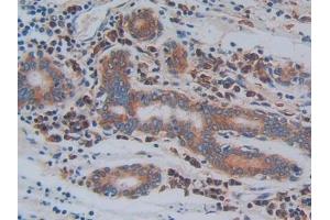 Detection of ITGb3 in Human Stomach cancer Tissue using Polyclonal Antibody to Integrin Beta 3 (ITGb3) (Integrin beta 3 antibody  (AA 135-377))