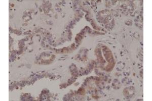 IHC testing of formalin fixed and paraffin embedded human thyroid cancer tissue with recombinant phospho-EIF2A antibody at 1:200 dilution. (Recombinant EIF2A antibody  (pSer51))