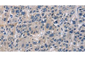 Immunohistochemistry of paraffin-embedded Human liver cancer tissue using ABI3BP Polyclonal Antibody at dilution 1:60 (ABI3BP antibody)