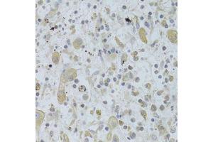 Immunohistochemistry of paraffin-embedded human liver cancer using MAP2K5 Antibody. (MAP2K5 antibody  (AA 1-190))