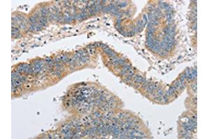 The image on the left is immunohistochemistry of paraffin-embedded Human colon cancer tissue using ABIN7128507(ARHGEF9 Antibody) at dilution 1/50, on the right is treated with fusion protein. (Arhgef9 antibody)