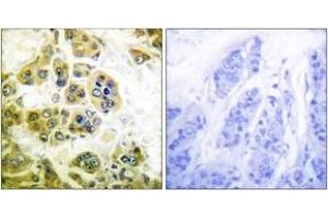 Immunohistochemistry analysis of paraffin-embedded human breast carcinoma tissue, using IKK-alpha/beta (Ab-180/181) Antibody. (IKK-alpha /IKK-beta antibody  (AA 141-190))