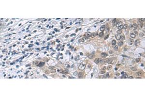 Immunohistochemistry of paraffin-embedded Human esophagus cancer tissue using IRS4 Polyclonal Antibody at dilution of 1:45(x200) (IRS4 antibody)