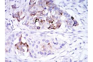 Immunohistochemical analysis of paraffin-embedded mammary cancer tissues using SCGB2A2 mouse mAb with DAB staining. (Mammaglobin A antibody)