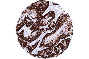 Squamous cell carcinoma of the esophagus with strong predominantly basal KRT14 immunostaining (Recombinant KRT14 antibody  (AA 350-472))