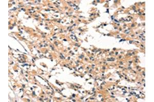The image on the left is immunohistochemistry of paraffin-embedded Human thyroid cancer tissue using ABIN7190422(CYP46A1 Antibody) at dilution 1/15, on the right is treated with synthetic peptide.
