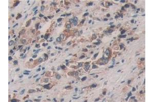 Detection of PDIA4 in Human Prostate cancer Tissue using Polyclonal Antibody to Protein Disulfide Isomerase A4 (PDIA4) (PDIA4 antibody  (AA 505-636))