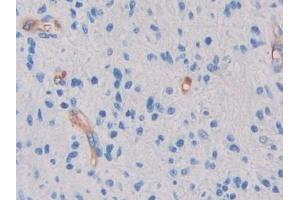 Detection of GC in Human Glioma Tissue using Polyclonal Antibody to Glycocalicin (GC) (Glycocalicin antibody  (AA 136-276))
