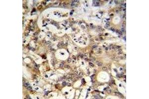 SP1 antibody immunohistochemistry analysis in formalin fixed and paraffin embedded human colon carcinoma. (SP1 antibody  (AA 677-707))